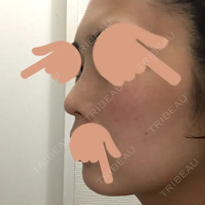 隆鼻術 / 鼻中隔延長（切開） / 斜鼻修正 / 真皮移植 / 鼻孔縁下降 加藤クリニック 麻布東京院 DAY 85 メイン用