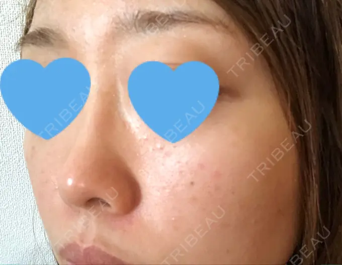 イオン導入 / 美肌レーザー / シミ取りレーザー / エレクトロポレーション 湘南美容クリニック 秋葉原院 DAY 7 メイン用