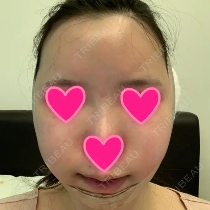 あごプロテーゼ / 骨切り（あご） / 骨削り（エラ） / 骨削り（頬） View美容整形外科 DAY 2 メイン用