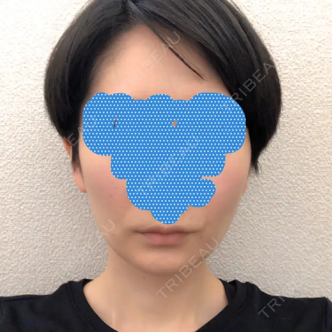 バッカルファット除去 / 脂肪吸引（顔） ジョウクリニック 大阪院 AFTER メイン用