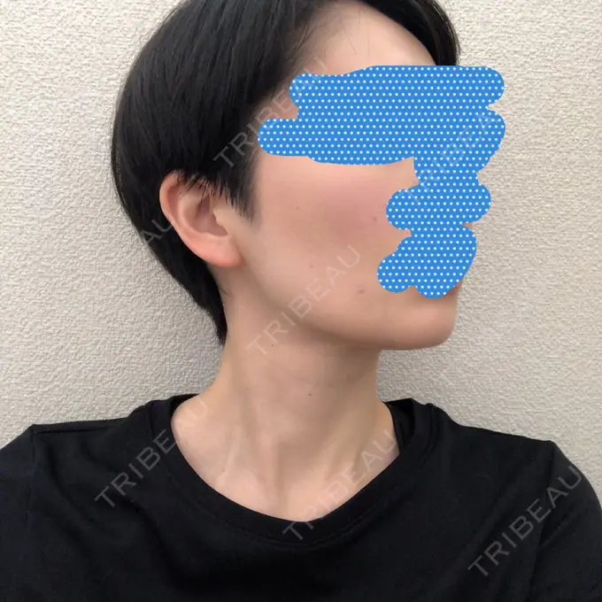 バッカルファット除去 / 脂肪吸引（顔） ジョウクリニック 大阪院 DAY 185 メイン用