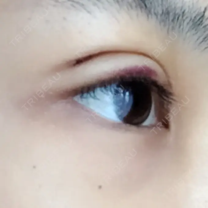 二重埋没 / 上まぶたの脂肪取り 金沢中央クリニック DAY 6 メイン用