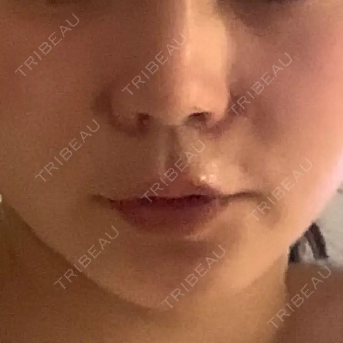 小鼻縮小（切開） / 鼻翼挙上 / 鼻孔縁挙上 大阪TAクリニック DAY 8 メイン用