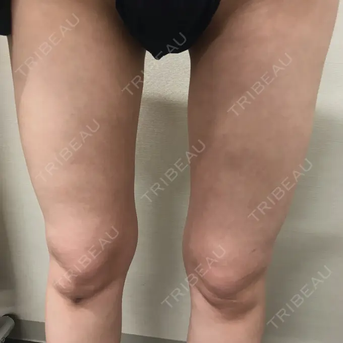 脂肪吸引（脚） / 豊胸（脂肪注入） THE CLINIC（ザ・クリニック） 名古屋院 DAY 92 メイン用