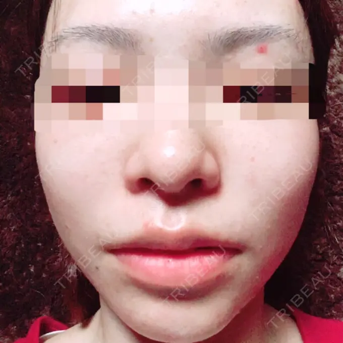 その他（目元） 青山セレスクリニック 青山院 AFTER メイン用