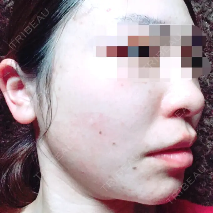 その他（目元） 青山セレスクリニック 青山院 DAY 77 メイン用