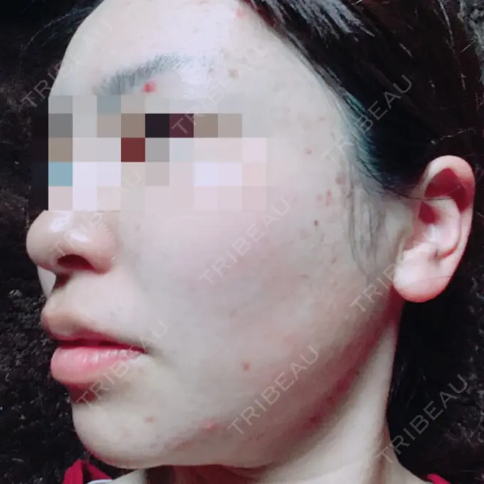 その他（目元） 青山セレスクリニック 青山院 DAY 77 メイン用