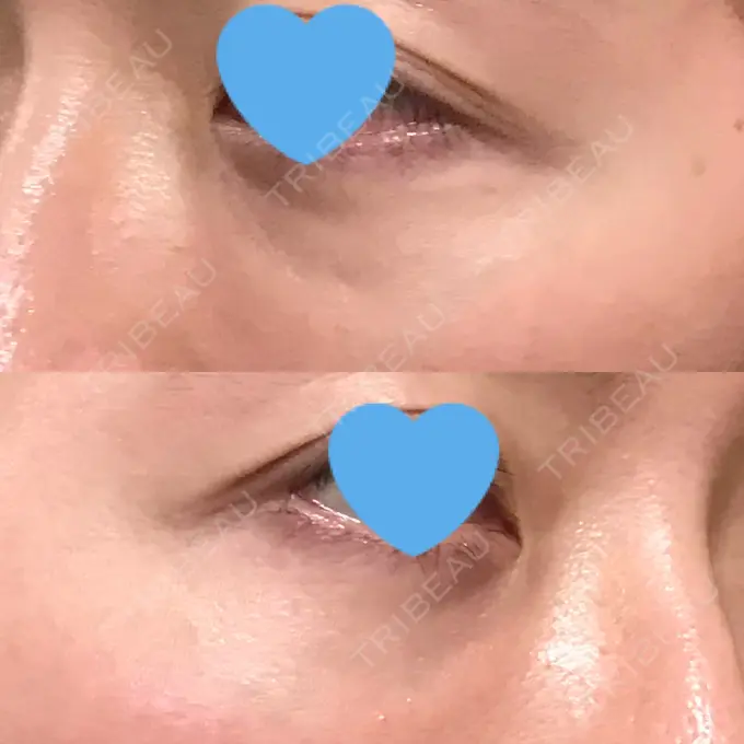 クマ治療 / 下まぶたたるみ取り / 下まぶたの脂肪取り 湘南美容クリニック 大阪あべの院 DAY 30 メイン用