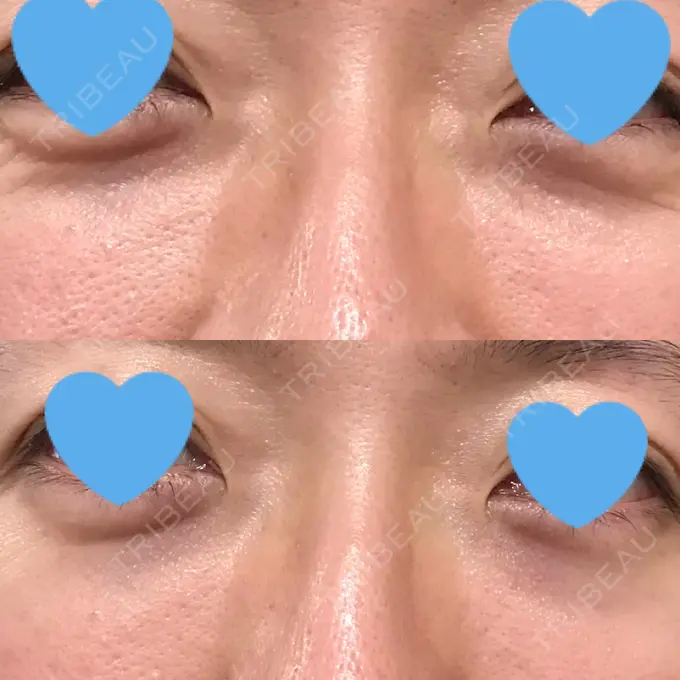 クマ治療 / 下まぶたたるみ取り / 下まぶたの脂肪取り 湘南美容クリニック 大阪あべの院 DAY 30 メイン用