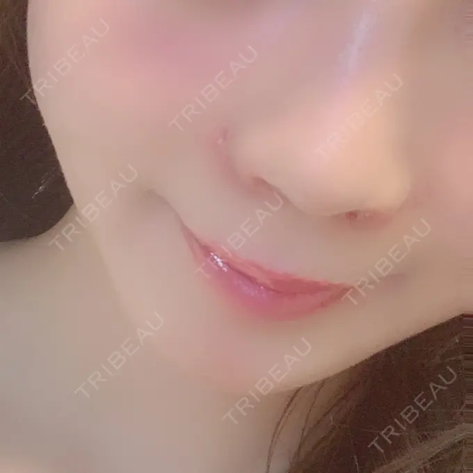 小鼻縮小（切開） / 鼻翼挙上 / 鼻孔縁挙上 大阪TAクリニック DAY 9 メイン用