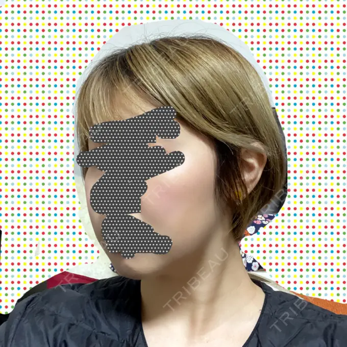 ボトックス（エラ・小顔） / 脂肪溶解注射（顔） チョンダムジュエンクリニック DAY 44 メイン用