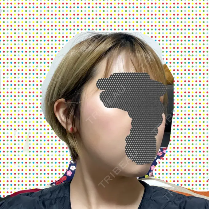 ボトックス（エラ・小顔） / 脂肪溶解注射（顔） チョンダムジュエンクリニック DAY 44 メイン用