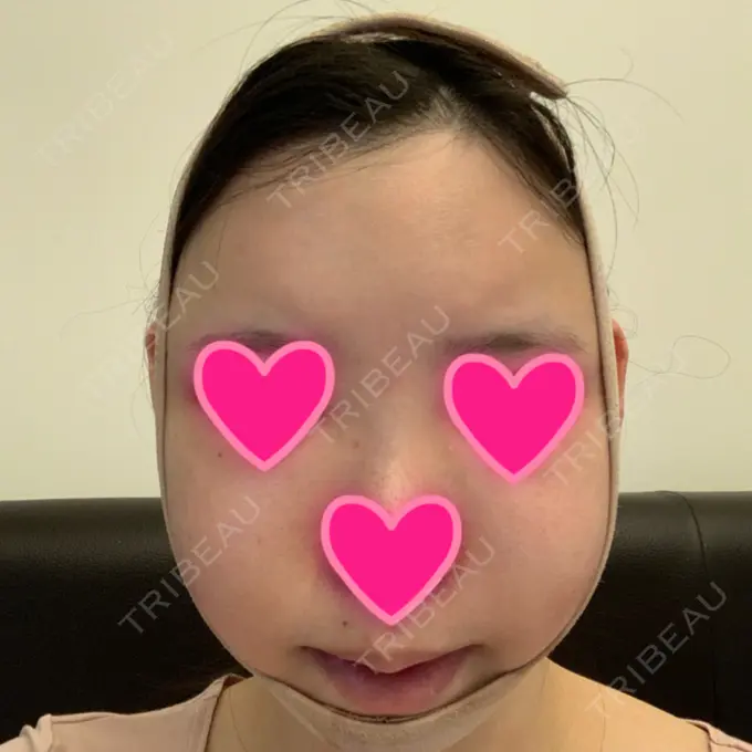 あごプロテーゼ / 骨切り（あご） / 骨削り（エラ） / 骨削り（頬） View美容整形外科 DAY 3 メイン用