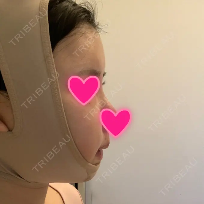 あごプロテーゼ / 骨切り（あご） / 骨削り（エラ） / 骨削り（頬） View美容整形外科 DAY 3 メイン用