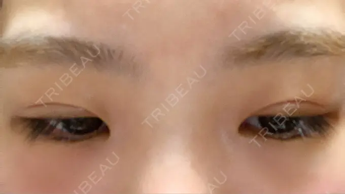 二重切開 きくな湯田眼科 DAY 23 メイン用