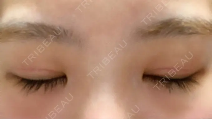 二重切開 きくな湯田眼科 DAY 23 メイン用