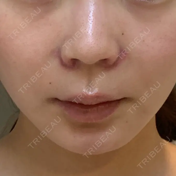 小鼻縮小（切開） / 鼻翼挙上 / 鼻孔縁挙上 大阪TAクリニック DAY 11 メイン用