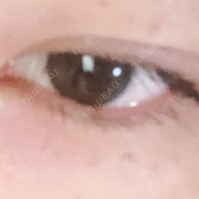 二重埋没 湘南美容クリニック 京都院 AFTER メイン用