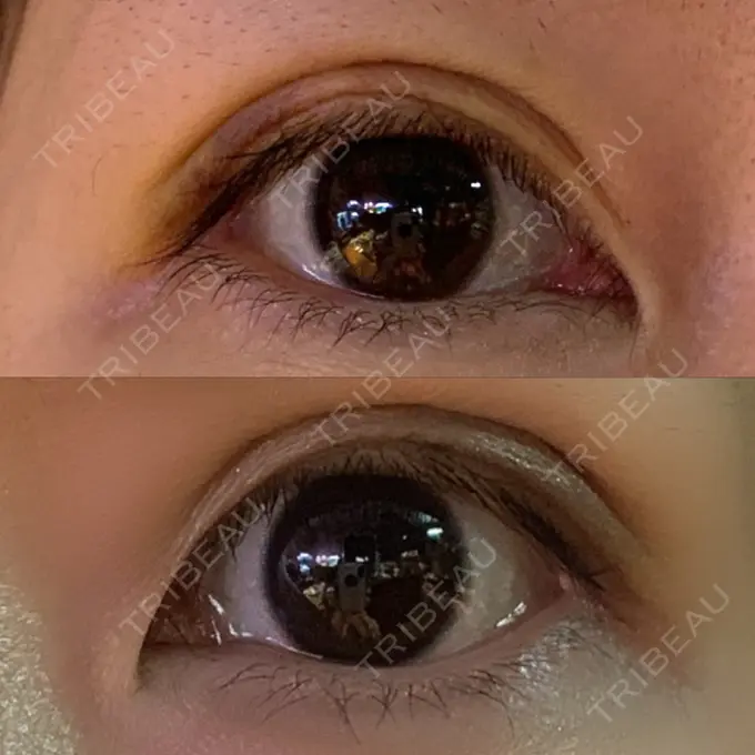 二重埋没 湘南美容クリニック 東京蒲田院 DAY 8 メイン用