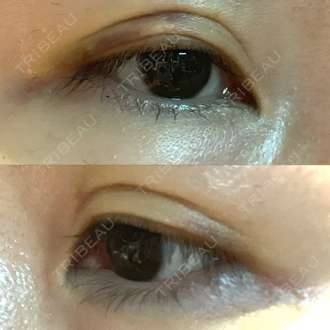 二重埋没 湘南美容クリニック 東京蒲田院 DAY 8 メイン用