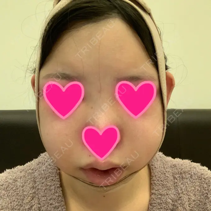 あごプロテーゼ / 骨切り（あご） / 骨削り（エラ） / 骨削り（頬） View美容整形外科 DAY 6 メイン用