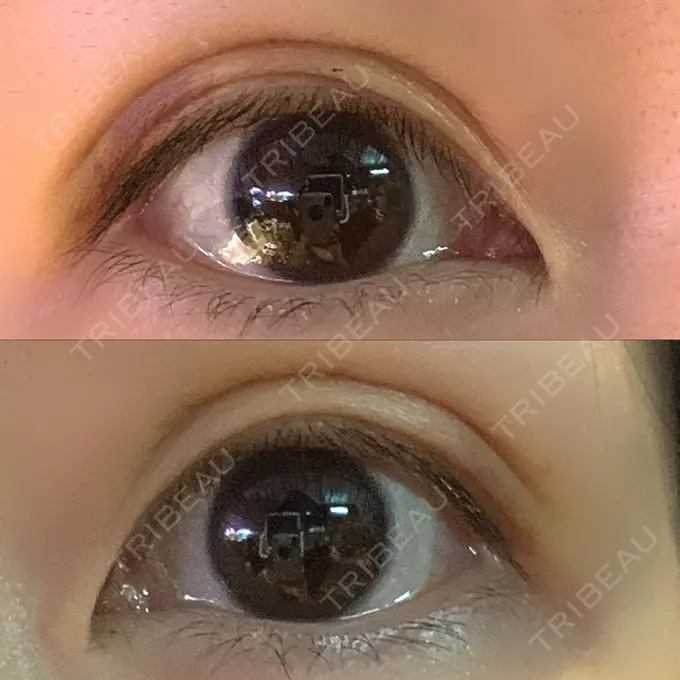 二重埋没 湘南美容クリニック 東京蒲田院 DAY 9 メイン用