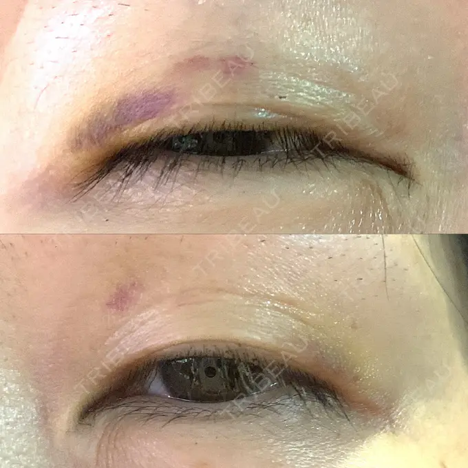 二重埋没 湘南美容クリニック 東京蒲田院 DAY 9 メイン用