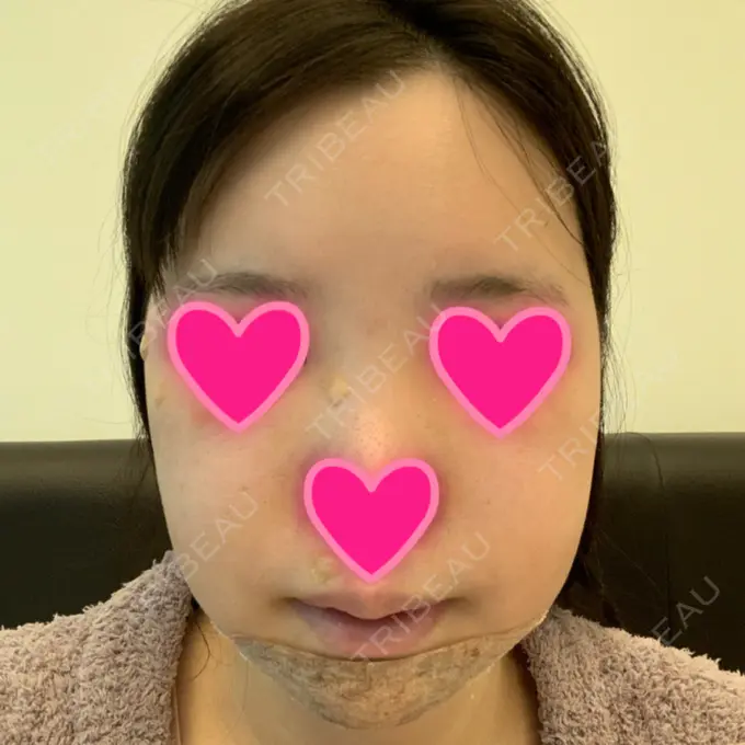 あごプロテーゼ / 骨切り（あご） / 骨削り（エラ） / 骨削り（頬） View美容整形外科 DAY 6 メイン用