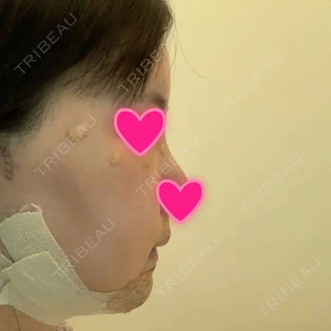 あごプロテーゼ / 骨切り（あご） / 骨削り（エラ） / 骨削り（頬） View美容整形外科 DAY 6 メイン用