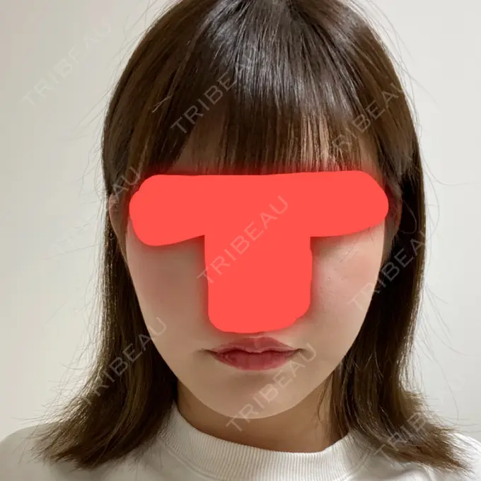 脂肪吸引（顔） / ボトックス（エラ・小顔） / 美容点滴・美容注射（美肌） エートップ美容整形外科 DAY 30 メイン用