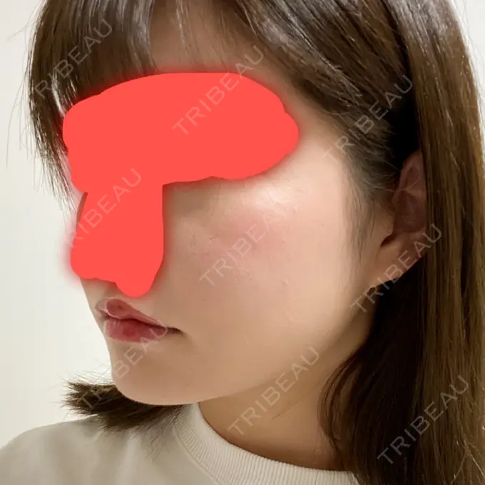 脂肪吸引（顔） / ボトックス（エラ・小顔） / 美容点滴・美容注射（美肌） エートップ美容整形外科 DAY 30 メイン用