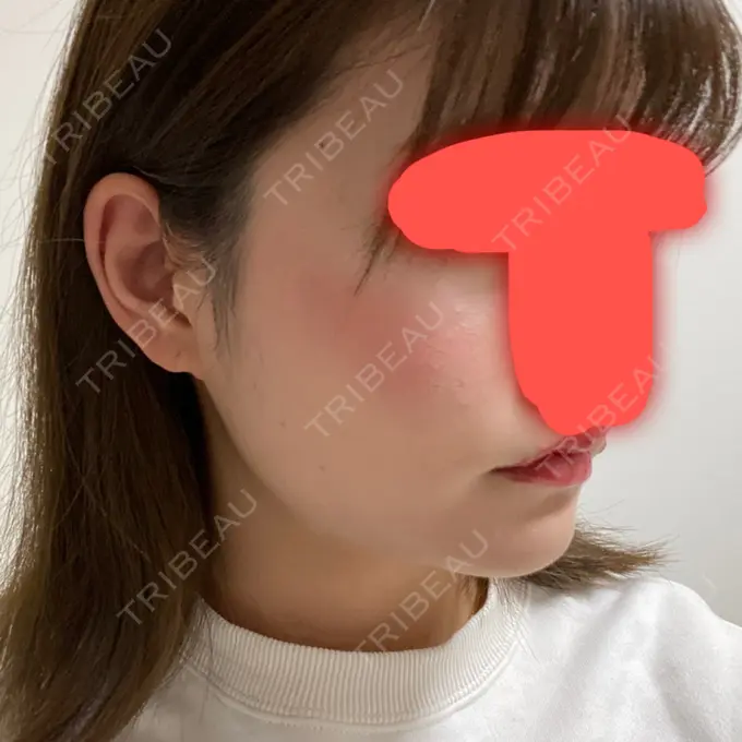 脂肪吸引（顔） / ボトックス（エラ・小顔） / 美容点滴・美容注射（美肌） エートップ美容整形外科 DAY 30 メイン用