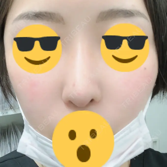 隆鼻術 / 軟骨移植 / 骨切幅寄せ / 鼻尖縮小 / その他（鼻） 韓国BBクリニック（旧 シンミアン形成外科） DAY 143 メイン用