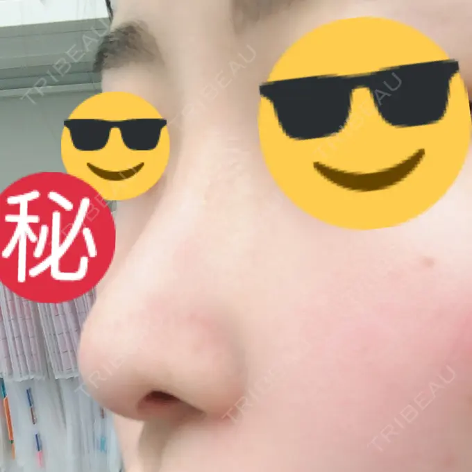 隆鼻術 / 軟骨移植 / 骨切幅寄せ / 鼻尖縮小 / その他（鼻） 韓国BBクリニック（旧 シンミアン形成外科） DAY 143 メイン用