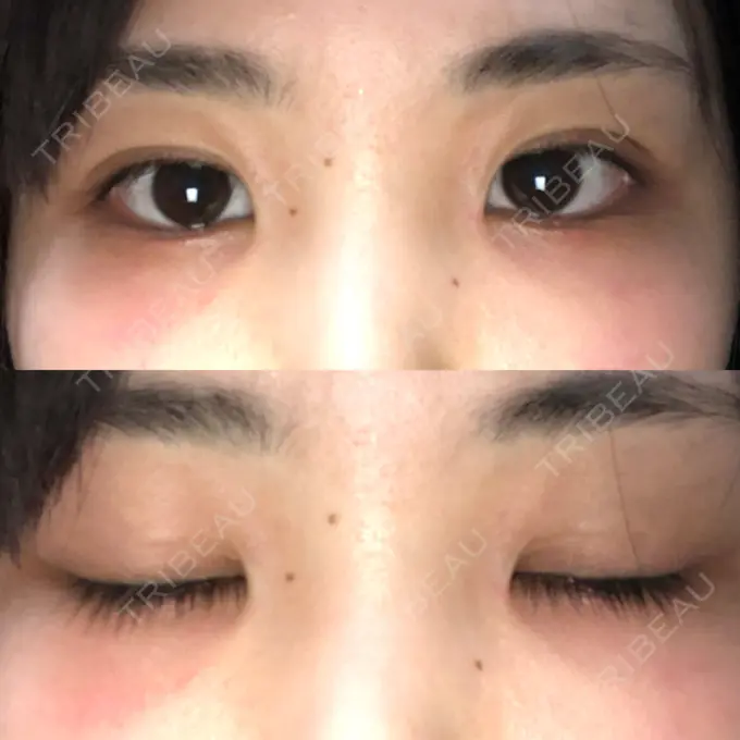 二重埋没 湘南美容クリニック 東京蒲田院 AFTER メイン用