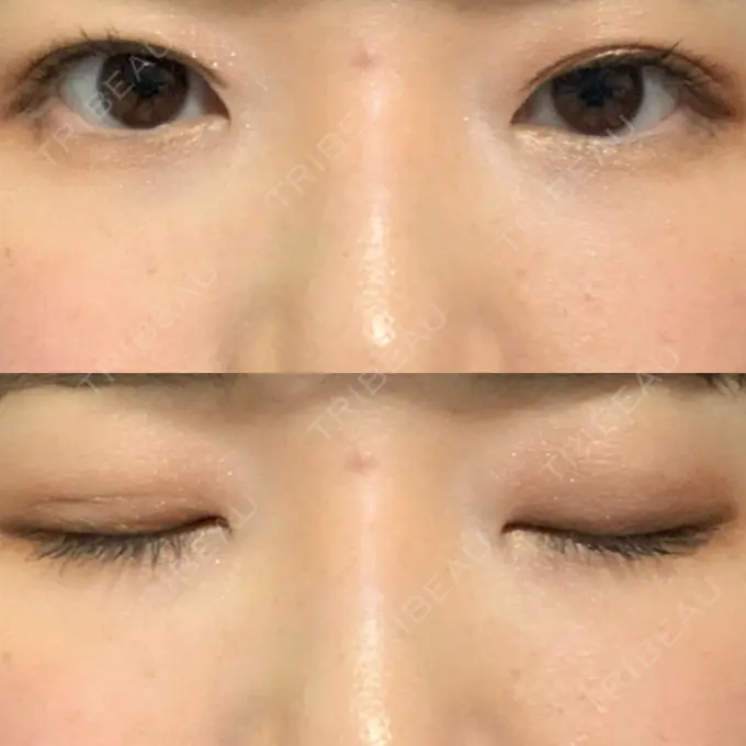 二重埋没 湘南美容クリニック 東京蒲田院 DAY 21 メイン用