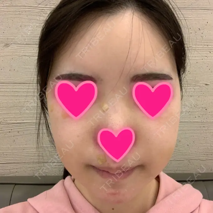 あごプロテーゼ / 骨切り（あご） / 骨削り（エラ） / 骨削り（頬） View美容整形外科 AFTER メイン用