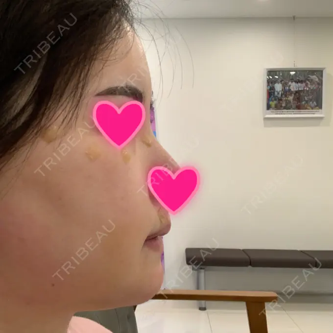 あごプロテーゼ / 骨切り（あご） / 骨削り（エラ） / 骨削り（頬） View美容整形外科 DAY 8 メイン用