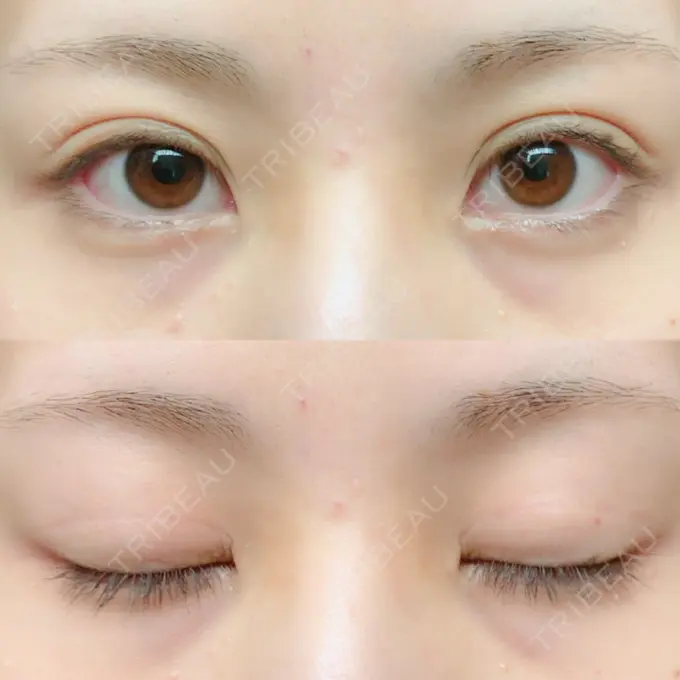 二重切開 / 上まぶたの脂肪取り / その他（目元） 銀座高須クリニック DAY 185 メイン用