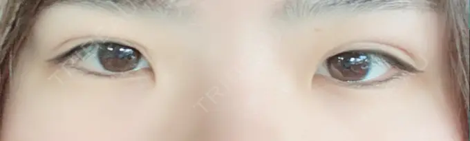 二重埋没 城本クリニック 豊橋院 DAY 3 メイン用