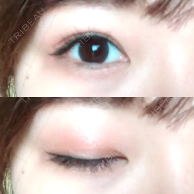 二重埋没 新宿美容外科クリニック 立川院 DAY 107 メイン用