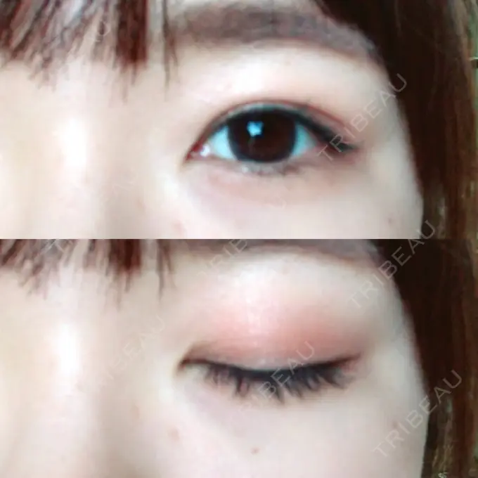 二重埋没 新宿美容外科クリニック 立川院 DAY 107 メイン用