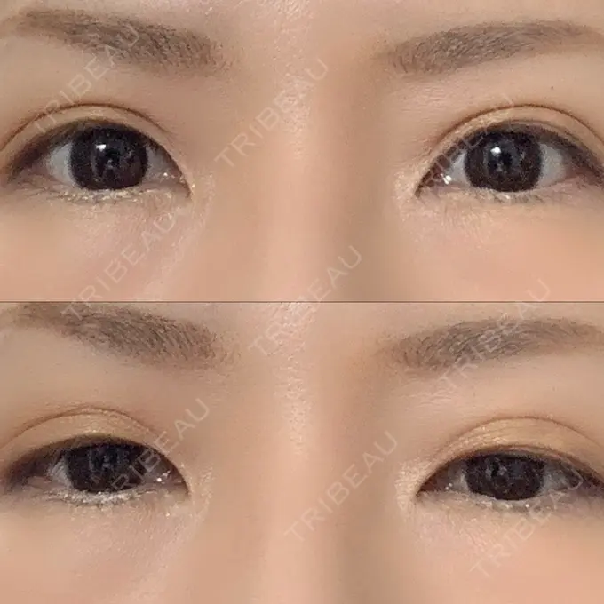 二重埋没 湘南美容クリニック 東京蒲田院 DAY 12 メイン用