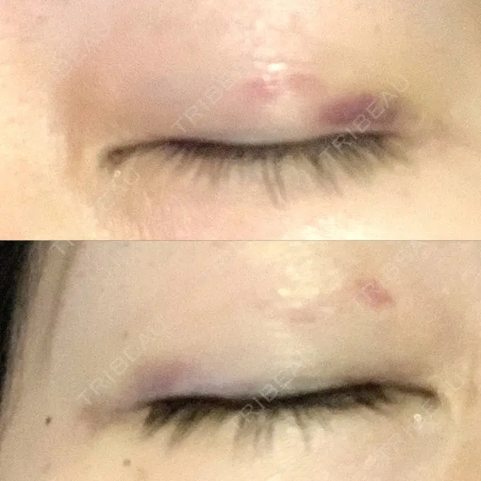 二重埋没 湘南美容クリニック 東京蒲田院 DAY 12 メイン用