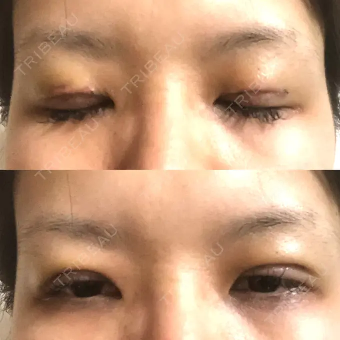 二重切開 / 目元修正 きくな湯田眼科 DAY 5 メイン用