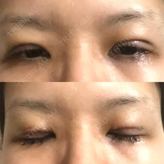 二重切開 / 目元修正 きくな湯田眼科 DAY 6 メイン用