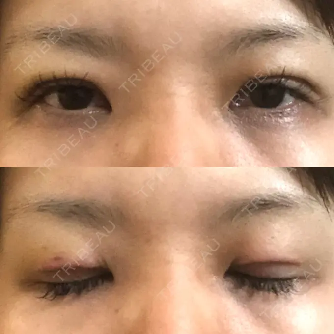 二重切開 / 目元修正 きくな湯田眼科 AFTER メイン用