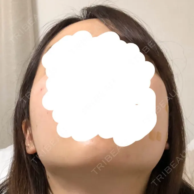 骨削り（頬） RG整形外科（旧リオン整形外科） DAY 92 メイン用