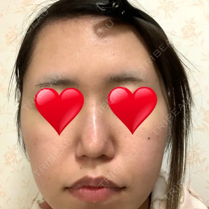 鼻尖形成（切開） / ヒアルロン酸注入（鼻） / その他（鼻） 高崎TAクリニック DAY 15 メイン用