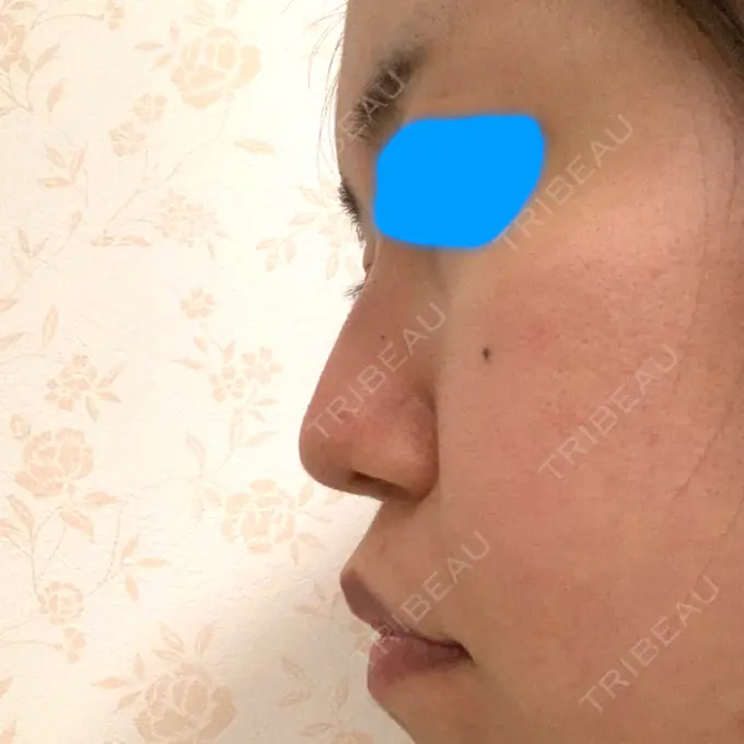 鼻尖形成（切開） / ヒアルロン酸注入（鼻） / その他（鼻） 高崎TAクリニック DAY 15 メイン用